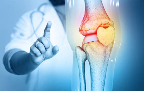 Cuidado de la salud articular: clave para transformar la calidad de vida en hemofilia.